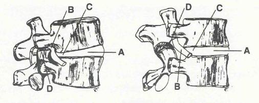 Goals of Spinal Traction